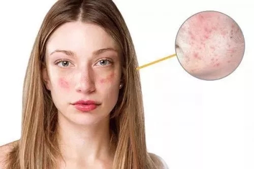 春季過敏不止你一個 預防要專業! 春季過敏不止你一個 預防要專業!